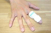 突き指の治療
