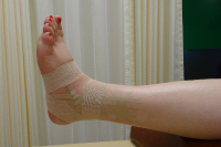 足関節捻挫の治療